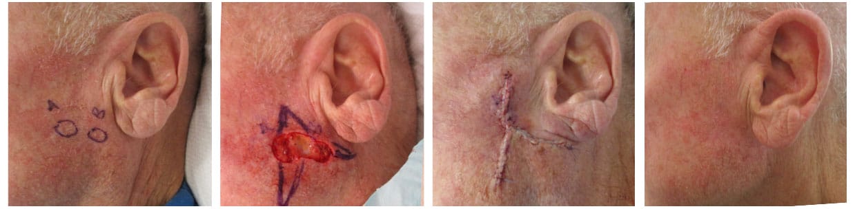 Mohs Surgery Before and After Photos