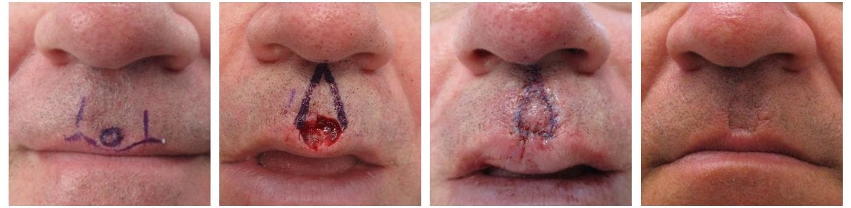 Mohs Surgery Before and After Photos